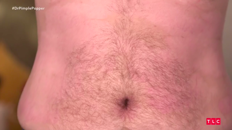 Illustration for article titled Dr. Pimple Popper Removes 68 Lipomas from One Person in Season 2 Premiere
